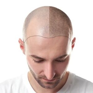 Hair Transplant surgery in Islamabad